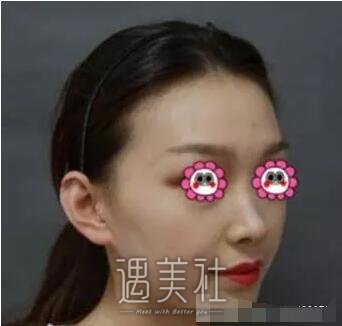游晓波隆鼻案例分享|颜值瞬间提升好几倍!