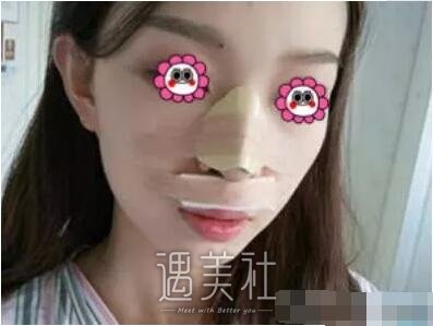 游晓波隆鼻案例分享|颜值瞬间提升好几倍!