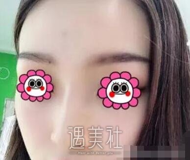 游晓波隆鼻案例分享|颜值瞬间提升好几倍!
