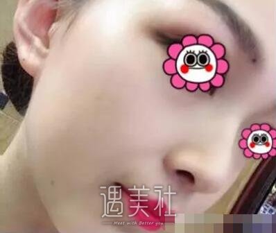 游晓波隆鼻案例分享|颜值瞬间提升好几倍!
