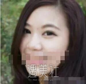 于智宏隆鼻案例展示|果越来越自然了!