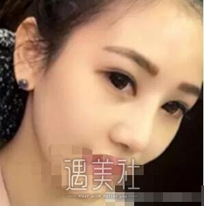 于智宏隆鼻案例展示|果越来越自然了!