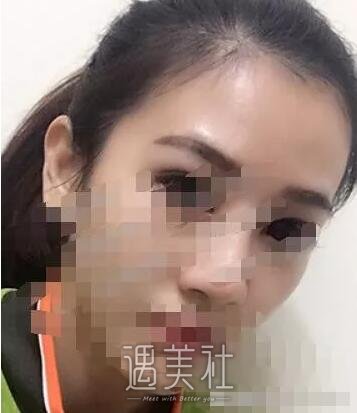 于智宏隆鼻案例展示|果越来越自然了!