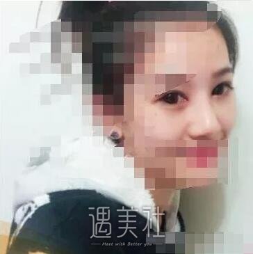 于智宏隆鼻案例展示|果越来越自然了!
