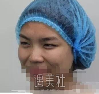 余东修复双眼皮案例分享|技术是真的好!