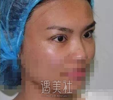 余东修复双眼皮案例分享|技术是真的好!
