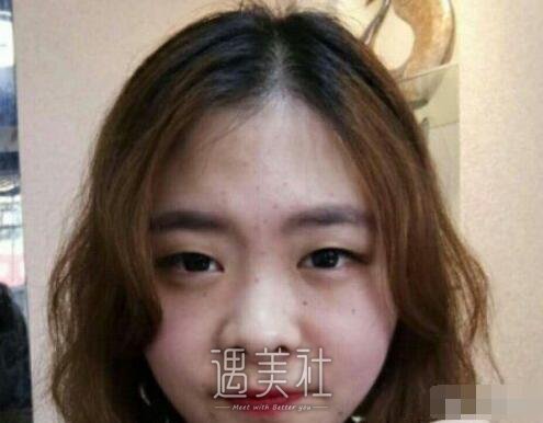张毅双眼皮案例展示|回头率瞬间提升!