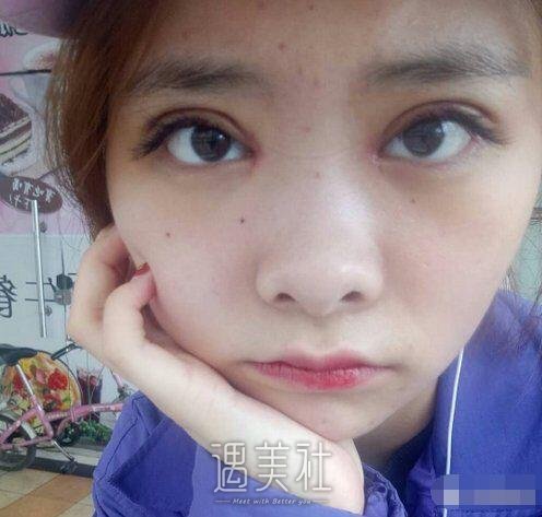 张毅双眼皮案例展示|回头率瞬间提升!