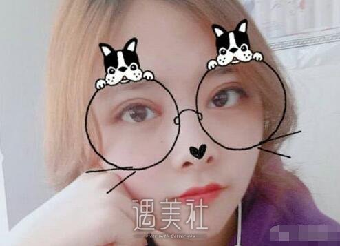 张毅双眼皮案例展示|回头率瞬间提升!