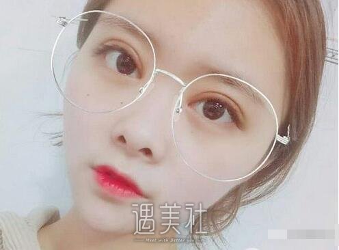 张毅双眼皮案例展示|回头率瞬间提升!
