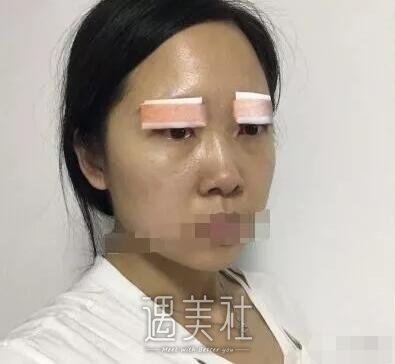张恒术双眼皮案例及果图展示|看看其技术到底如何!