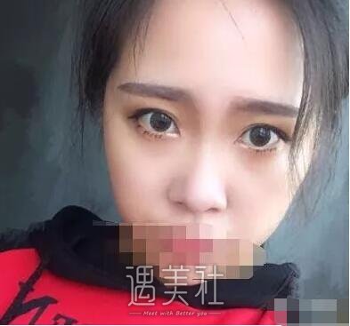 张恒术双眼皮案例及果图展示|看看其技术到底如何!