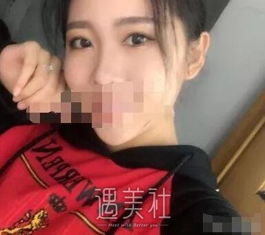 张恒术双眼皮案例及果图展示|看看其技术到底如何!