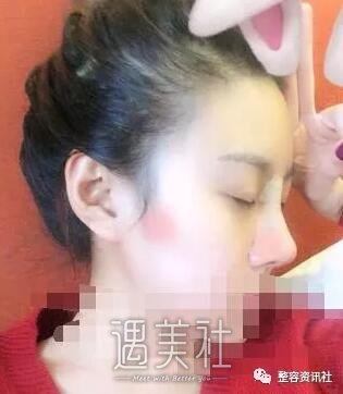 张怀军的隆鼻案例|魅力瞬间提升!