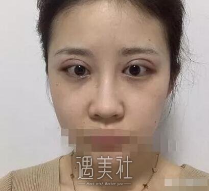 张黎双眼皮案例分享|终于小眼变大眼了!