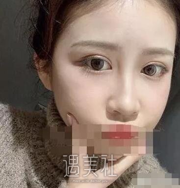 张黎双眼皮案例分享|终于小眼变大眼了!