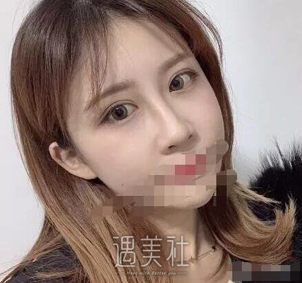 张黎双眼皮案例分享|终于小眼变大眼了!
