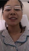 王振军双眼皮案例：大眼萌妹诞生记~ width=