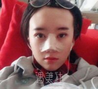 薇琳高志丹隆鼻案例：真实隆鼻变化分享~ width=