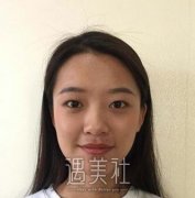 五洲刘俊案例双眼皮：真实对比图记录~ width=