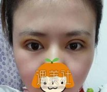 刘育凤双眼皮案例：一双眼睛真的可以改变一个人 width=