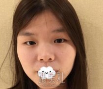 刘育凤案例双眼皮：比原来好看太多了 width=