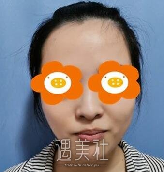 南京,李俊,隆鼻