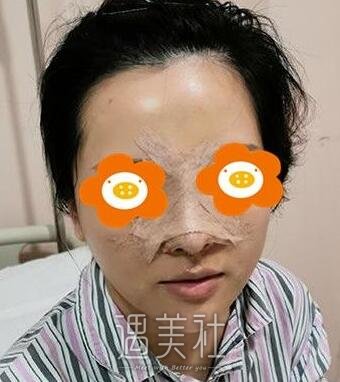 南京,李俊,隆鼻
