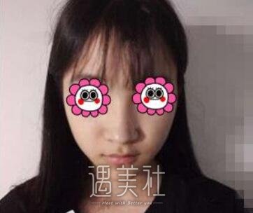 师俊莉,隆鼻