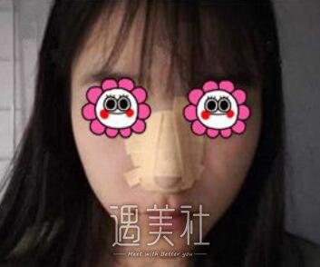 师俊莉,隆鼻