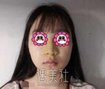 师俊莉,隆鼻