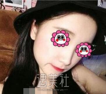 师俊莉,隆鼻