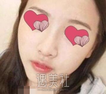 深圳,福田武警医院,隆鼻