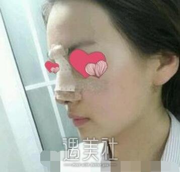 深圳,福田武警医院,隆鼻
