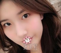 盛飞双眼皮案例:出门只要化个淡妆就美美哒 width=
