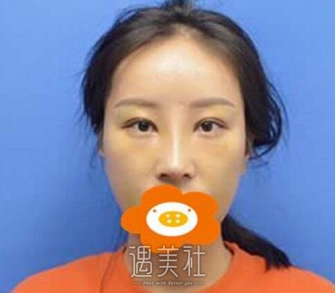汪立川,隆鼻
