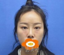 汪立川隆鼻案例:邻居姐姐说我变了~ width=