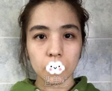 唐振利隆鼻案例：面部立体了，看着很自然 width=