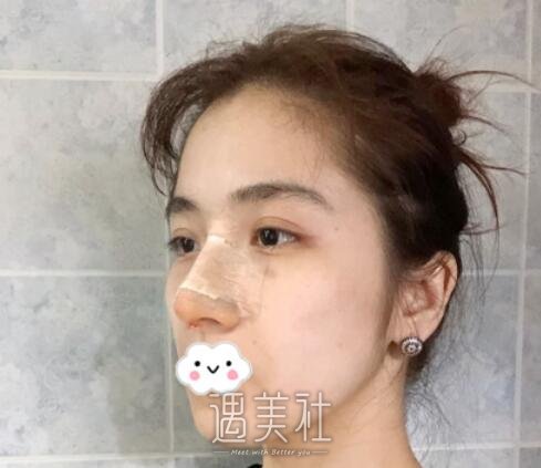 唐振利,隆鼻
