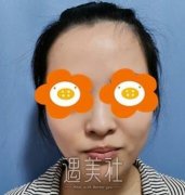 刘彦军隆鼻案例：和我五官特别的相配 width=