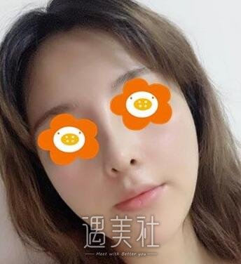刘彦军,隆鼻