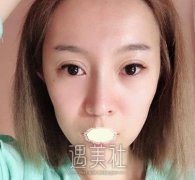 冯斌脂肪填充案例：额头饱满更显少女感~ width=
