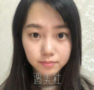 高难度双眼皮修复案例：找对医生真的改变人生！ width=