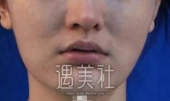 何照华颧骨下颌角案例，收获高颜值的小v脸！ width=