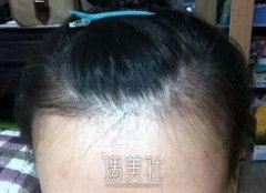 杭州市一医院植发的案例：满头秀发更显年轻~ width=