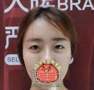 焦俊光双眼皮修复案例，出门逛街回头率都高啦~ width=