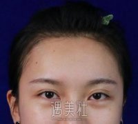 军美双眼皮修复案例：宛如天生就是如此！ width=