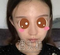 路海军隆鼻案例分享，鼻梁变得又高又直~ width=