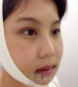 石家庄美联臣整形医院磨骨案例一览|终于摆脱大脸盘! width=