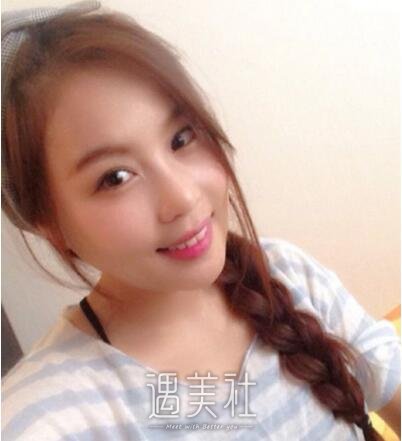 石家庄美联臣整形医院磨骨案例一览|终于摆脱大脸盘!
